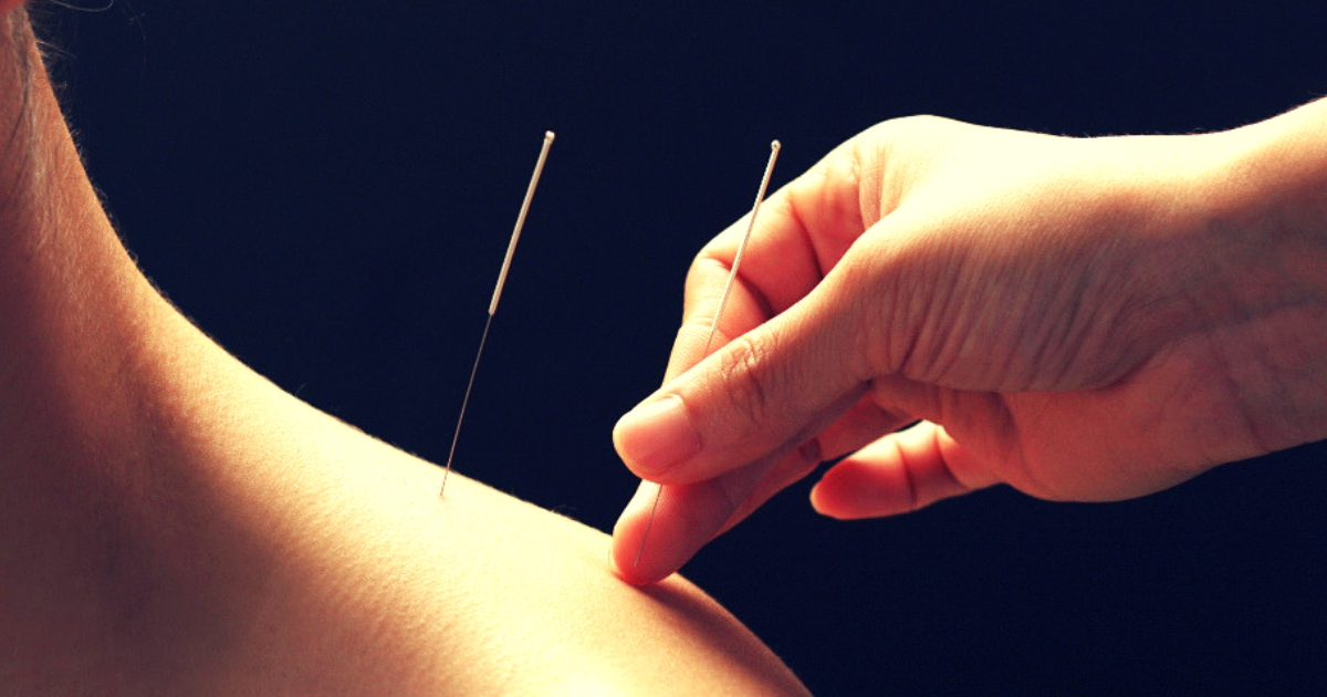Amazing New Acupuncture Techniques