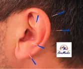 FastTrack NADA Addiction Protocol Style Ear Acupuncture (Level 3) 14 April at AcuMedic Centre