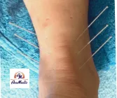 Accelerated Tendon Healing (level 5) 8 Sept. 2024 at AcuMedic Centre